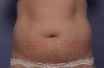 CoolSculpting® Before and after photo