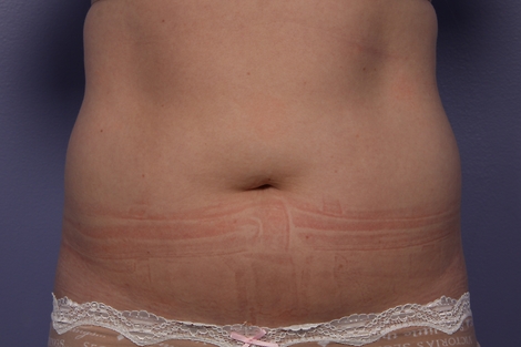 CoolSculpting® before and after photo