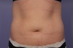 CoolSculpting® Before and after photo