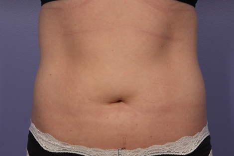 CoolSculpting® before and after photo