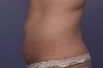 CoolSculpting® Before and after photo