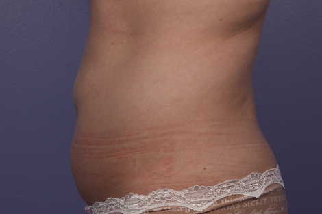 CoolSculpting® before and after photo