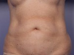 CoolSculpting® Before and after photo