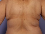 CoolSculpting® Before and after photo