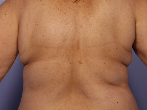 CoolSculpting® before and after photo