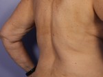 CoolSculpting® Before and after photo