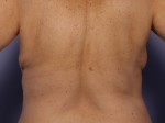 CoolSculpting® Before and after photo