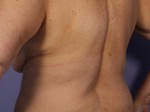 CoolSculpting® Before and after photo