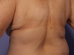 CoolSculpting® Before and after photo