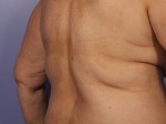 CoolSculpting® Before and after photo