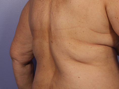 CoolSculpting® before and after photo