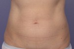 CoolSculpting®