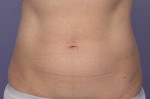 CoolSculpting® Before and after photo