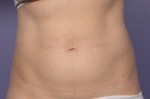 CoolSculpting® Before and after photo