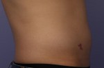 CoolSculpting® Before and after photo