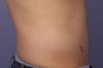 CoolSculpting® Before and after photo