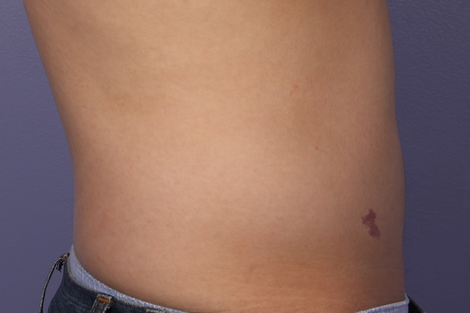 CoolSculpting® before and after photo