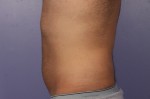 CoolSculpting®