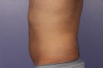 CoolSculpting® Before and after photo