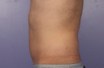 CoolSculpting® Before and after photo