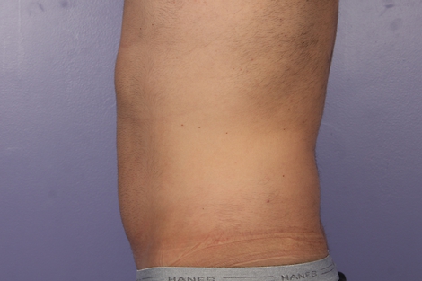 CoolSculpting® before and after photo