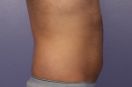 CoolSculpting® Before and after photo