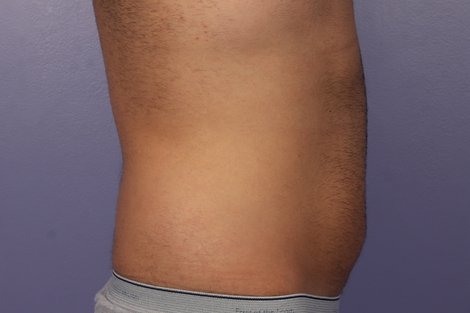 CoolSculpting® before and after photo