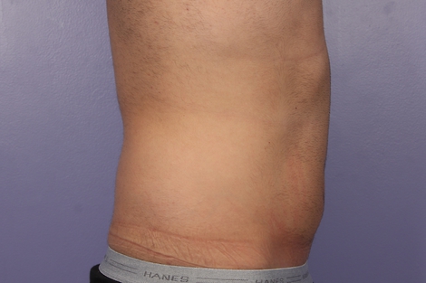 CoolSculpting® before and after photo