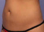 CoolSculpting® Before and after photo