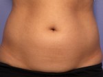 CoolSculpting® Before and after photo