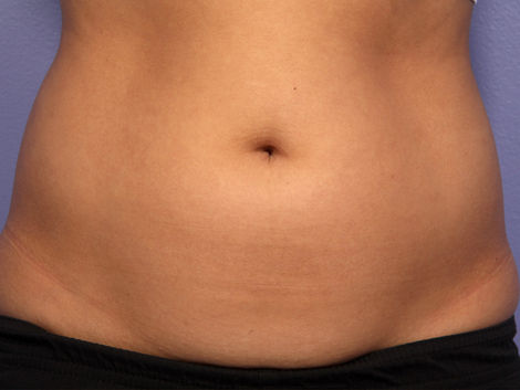 CoolSculpting® before and after photo