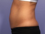 CoolSculpting® Before and after photo