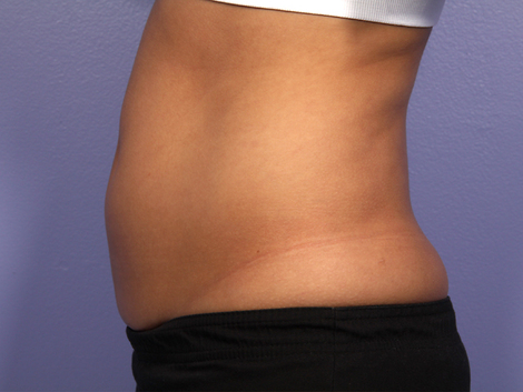 CoolSculpting® before and after photo