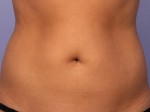 CoolSculpting® Before and after photo