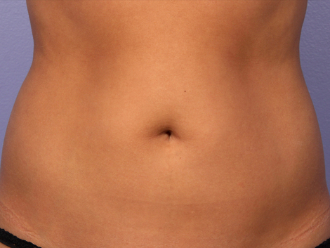 CoolSculpting® before and after photo