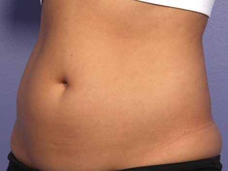 CoolSculpting® before and after photo