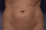 CoolSculpting® Before and after photo