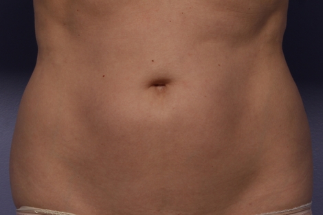 CoolSculpting® before and after photo