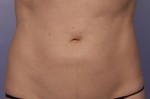 CoolSculpting® Before and after photo