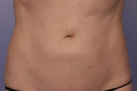 CoolSculpting® before and after photo