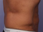 CoolSculpting® Before and after photo