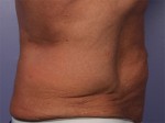 CoolSculpting® Before and after photo