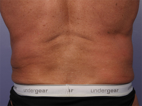 CoolSculpting® before and after photo