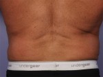 CoolSculpting® Before and after photo