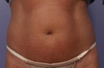 CoolSculpting® Before and after photo