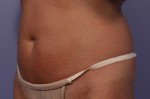 CoolSculpting® Before and after photo