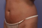 CoolSculpting® Before and after photo