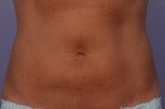 CoolSculpting® Before and after photo