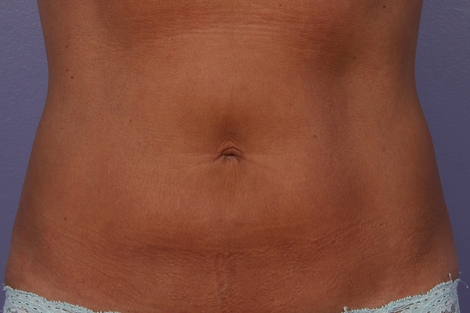 CoolSculpting® before and after photo