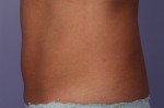 CoolSculpting® Before and after photo